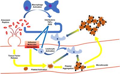 The Role of Thromboinflammation in Delayed Cerebral Ischemia after Subarachnoid Hemorrhage
